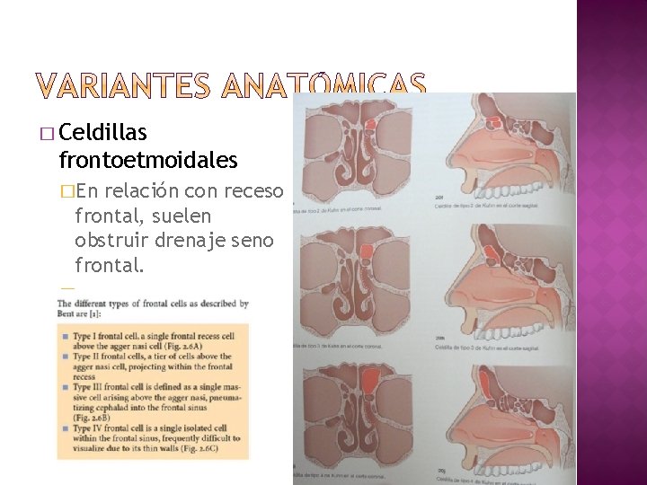 � Celdillas frontoetmoidales �En relación con receso frontal, suelen obstruir drenaje seno frontal. �.
