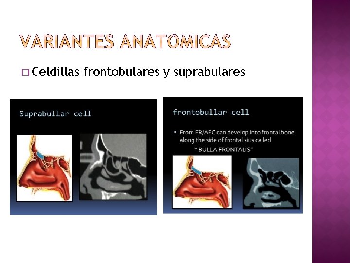 � Celdillas frontobulares y suprabulares 