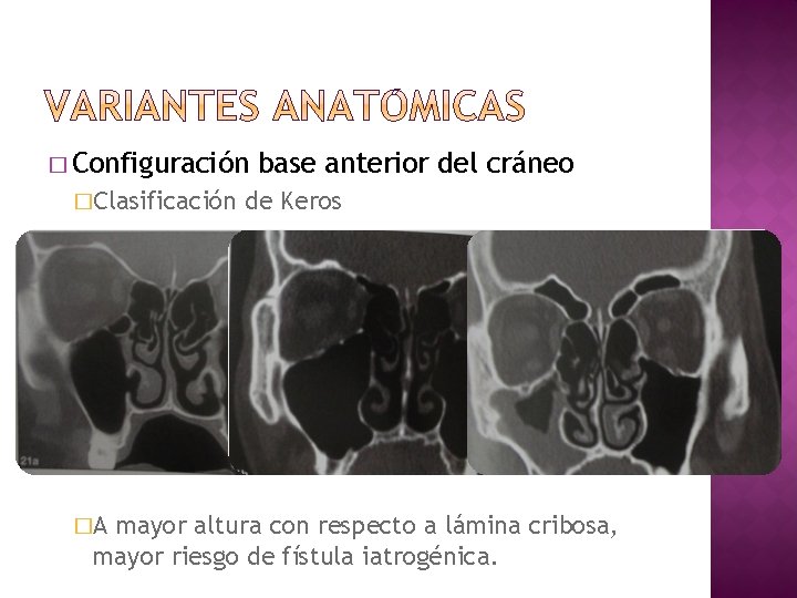 � Configuración �Clasificación �A base anterior del cráneo de Keros mayor altura con respecto