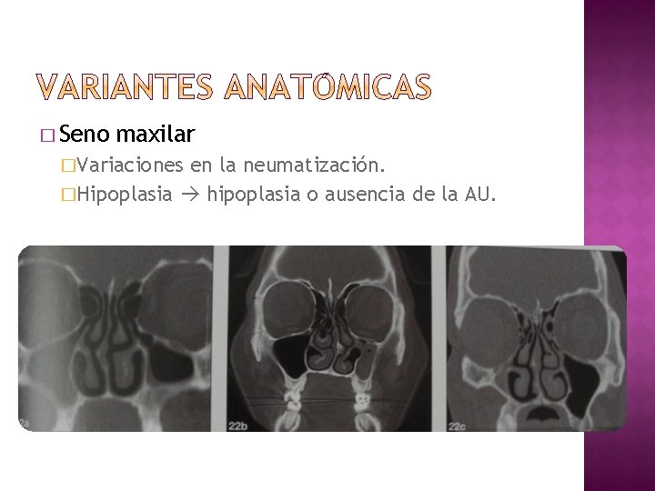 � Seno maxilar �Variaciones en la neumatización. �Hipoplasia hipoplasia o ausencia de la AU.