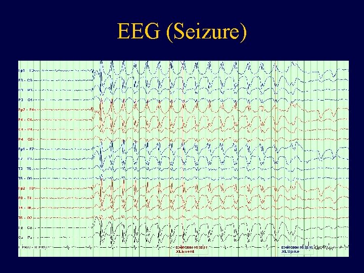 EEG (Seizure) 12 