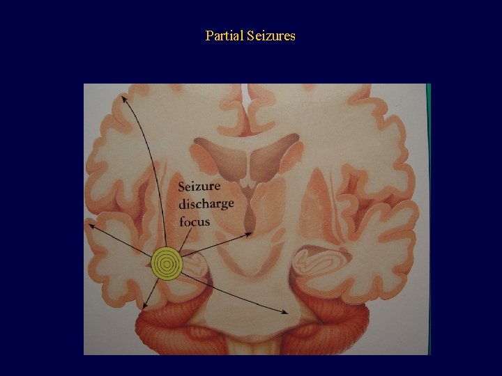 Partial Seizures 