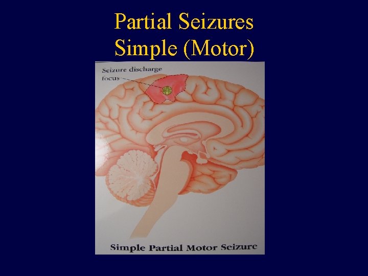 Partial Seizures Simple (Motor) 