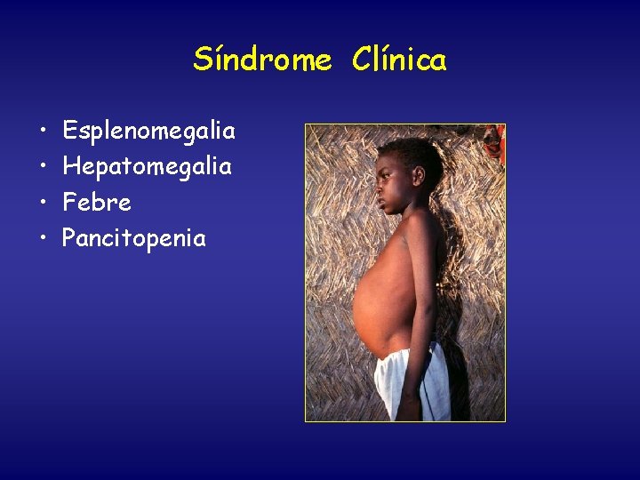 Síndrome Clínica • • Esplenomegalia Hepatomegalia Febre Pancitopenia 