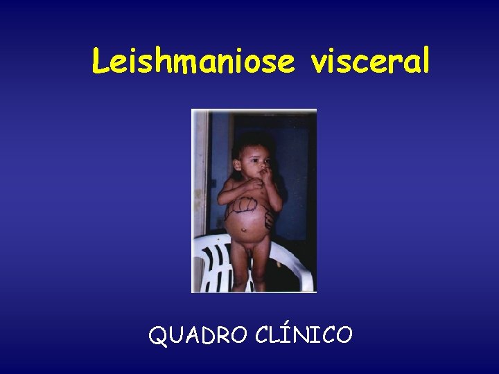 Leishmaniose visceral QUADRO CLÍNICO 