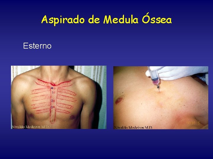 Aspirado de Medula Óssea Esterno 
