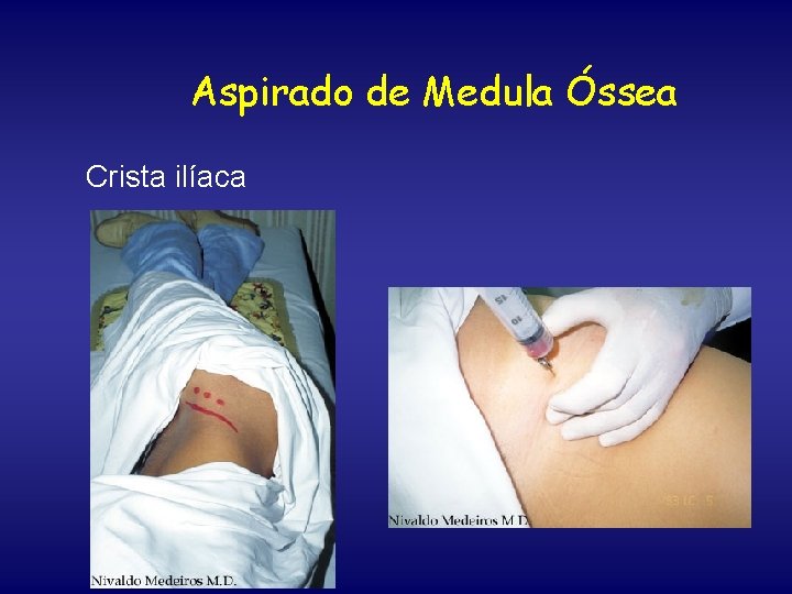 Aspirado de Medula Óssea Crista ilíaca 