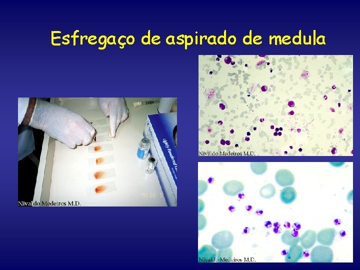 Esfregaço de aspirado de medula 