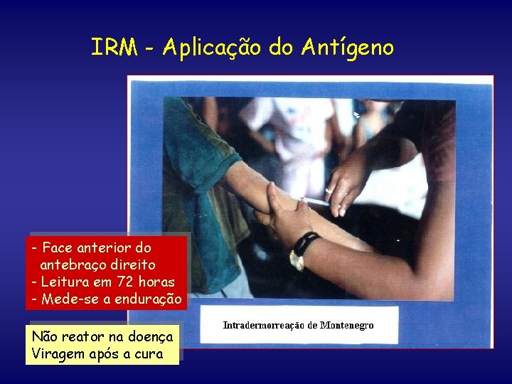 IRM - Aplicação do Antígeno - Face anterior do antebraço direito - Leitura em