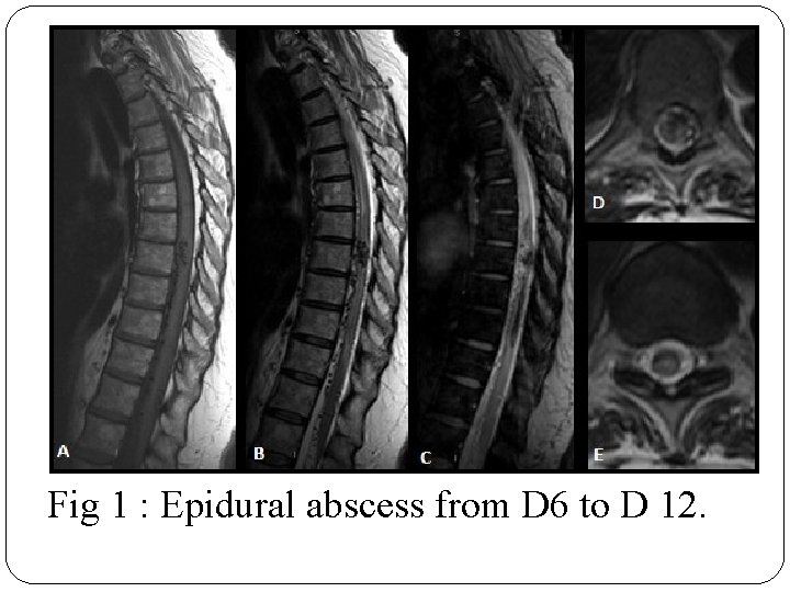 Fig 1 : Epidural abscess from D 6 to D 12. 