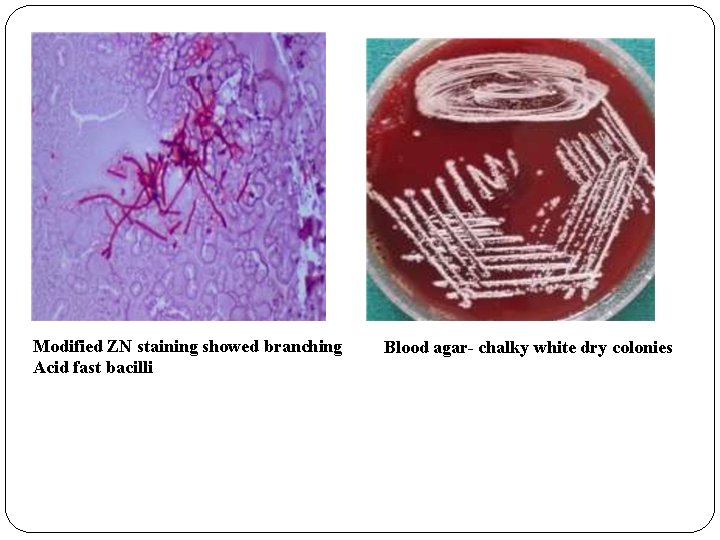 Modified ZN staining showed branching Acid fast bacilli Blood agar- chalky white dry colonies