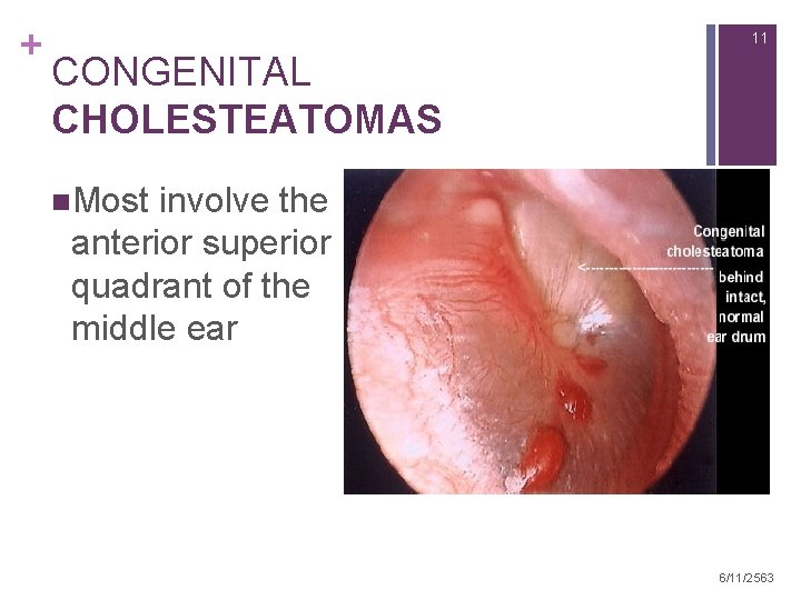 + 11 CONGENITAL CHOLESTEATOMAS n. Most involve the anterior superior quadrant of the middle