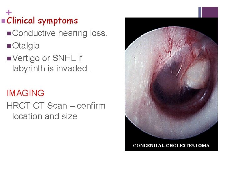 + n Clinical symptoms n Conductive hearing loss. n Otalgia n Vertigo or SNHL