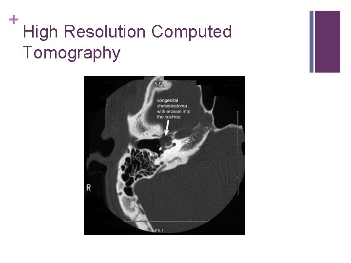 + High Resolution Computed Tomography 