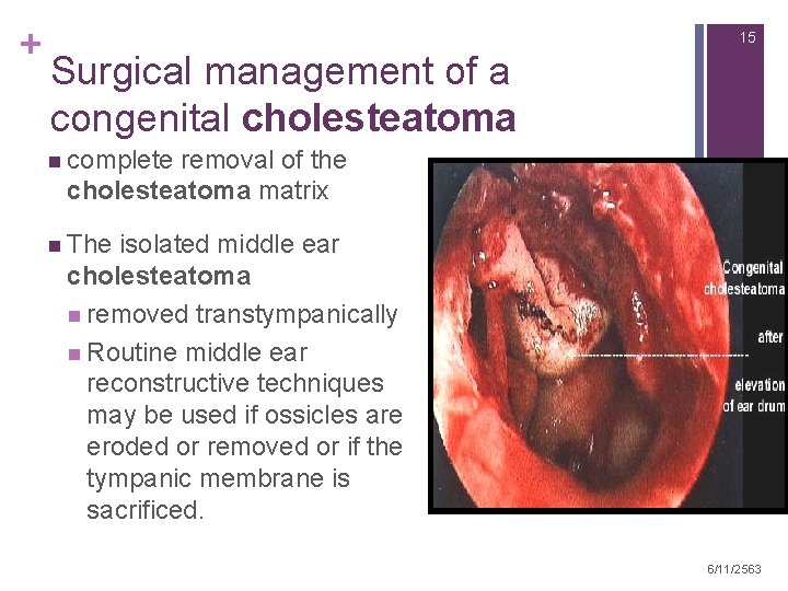 + 15 Surgical management of a congenital cholesteatoma n complete removal of the cholesteatoma