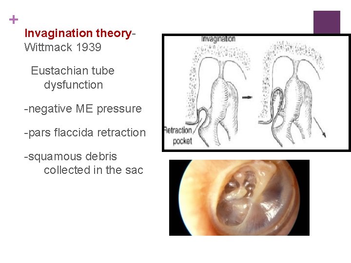 + Invagination theory. Wittmack 1939 Eustachian tube dysfunction -negative ME pressure -pars flaccida retraction