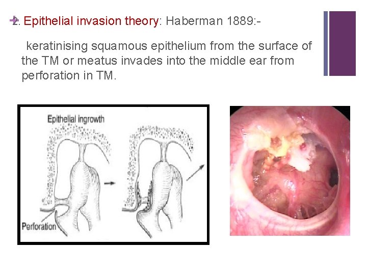 +2. Epithelial invasion theory: Haberman 1889: keratinising squamous epithelium from the surface of the