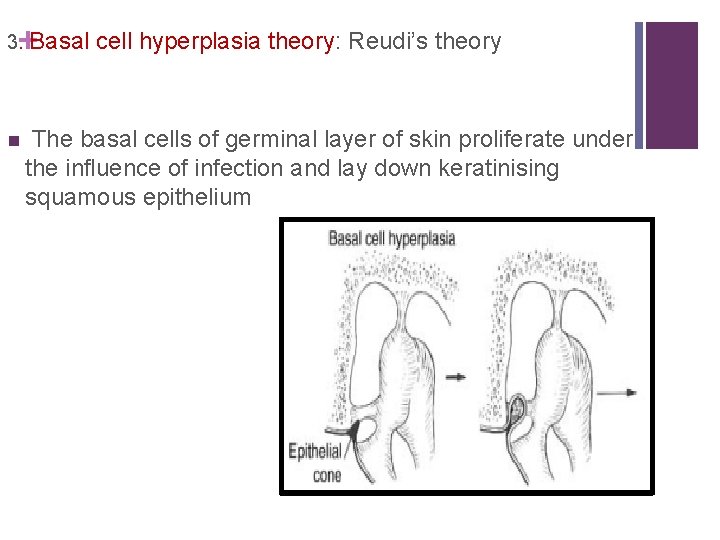 + 3. Basal n cell hyperplasia theory: Reudi’s theory The basal cells of germinal