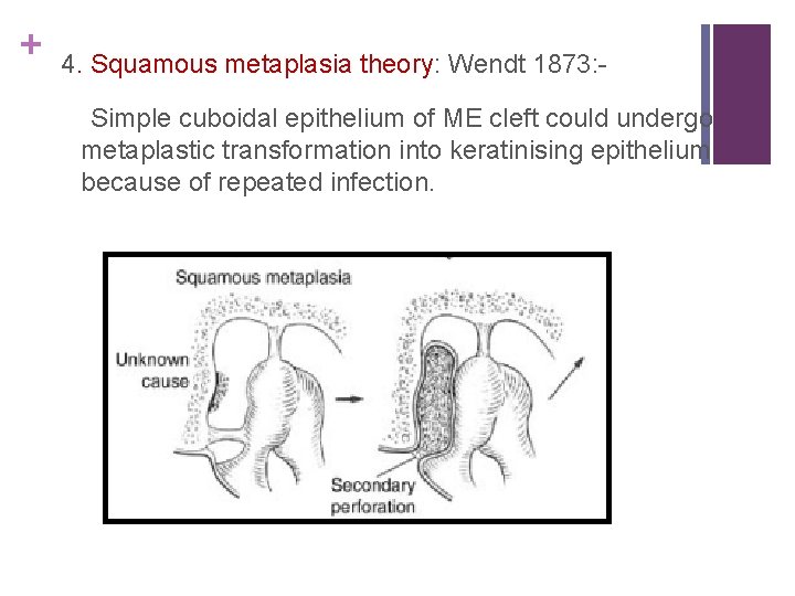 + 4. Squamous metaplasia theory: Wendt 1873: Simple cuboidal epithelium of ME cleft could