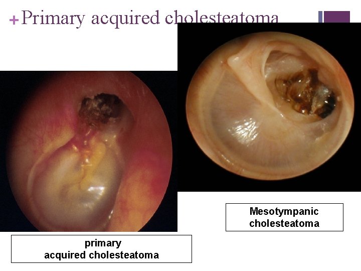 + Primary acquired cholesteatoma Normal TM Mesotympanic cholesteatoma primary acquired cholesteatoma 