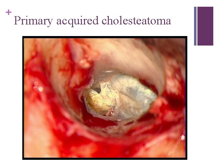 + Primary acquired cholesteatoma 