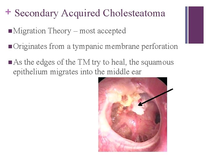 + Secondary Acquired Cholesteatoma n Migration Theory – most accepted n Originates from a