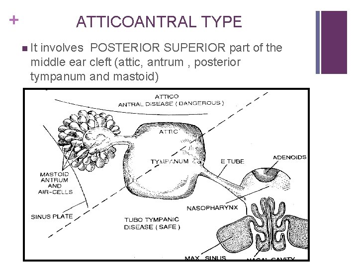 + ATTICOANTRAL TYPE n It involves POSTERIOR SUPERIOR part of the middle ear cleft