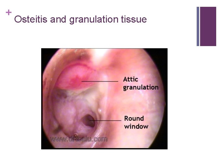 + Osteitis and granulation tissue 