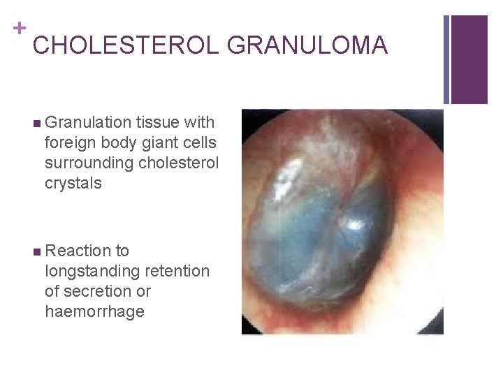 + CHOLESTEROL GRANULOMA n Granulation tissue with foreign body giant cells surrounding cholesterol crystals