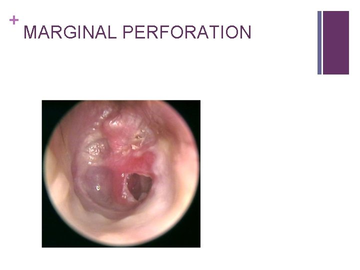 + MARGINAL PERFORATION 