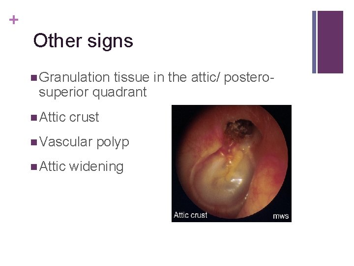 + Other signs n Granulation tissue in the attic/ posterosuperior quadrant n Attic crust