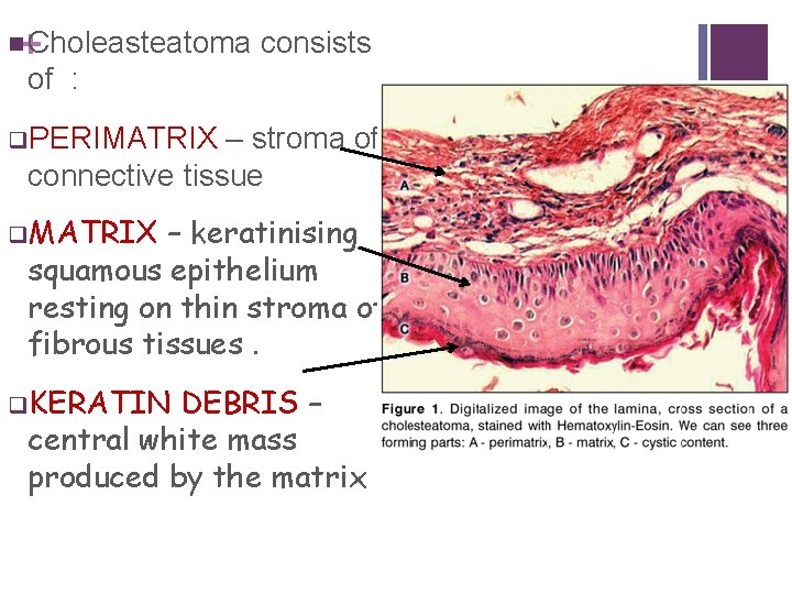 + n Choleasteatoma consists of : q. PERIMATRIX – stroma of connective tissue q.