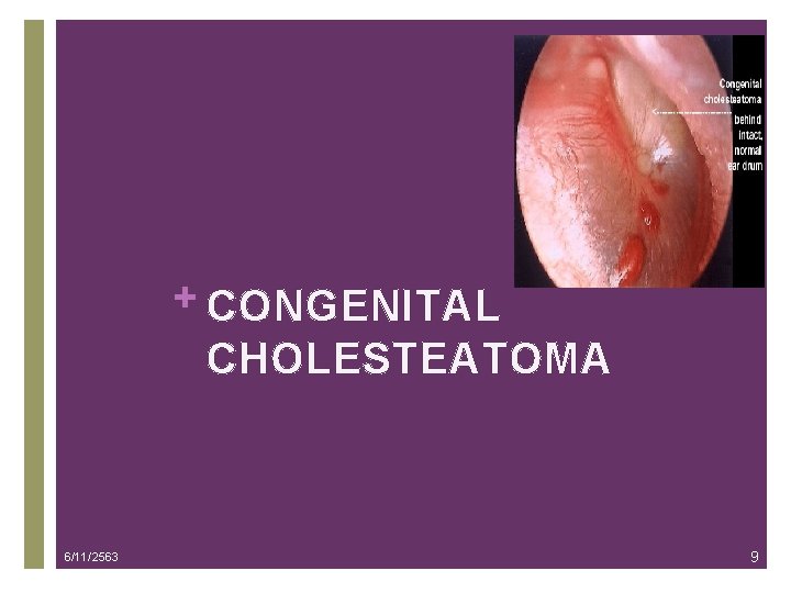 + CONGENITAL CHOLESTEATOMA 6/11/2563 9 