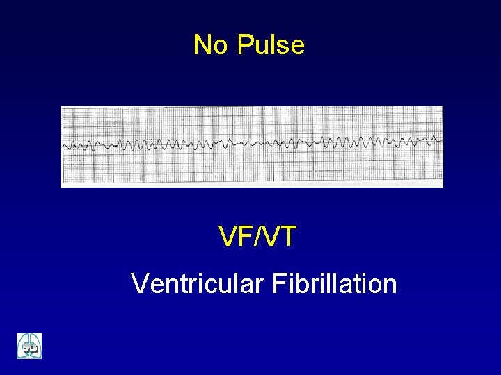 No Pulse VF/VT Ventricular Fibrillation 