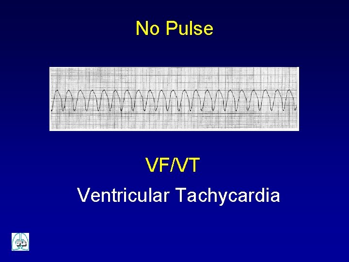 No Pulse VF/VT Ventricular Tachycardia 