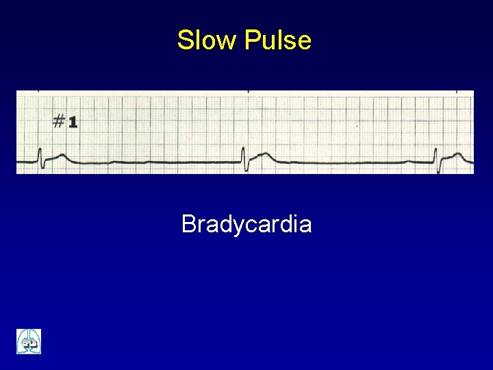 Slow Pulse Bradycardia 