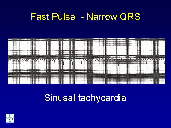 Fast Pulse - Narrow QRS Sinusal tachycardia 
