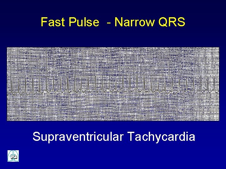 Fast Pulse - Narrow QRS Supraventricular Tachycardia 