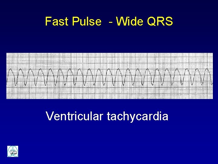 Fast Pulse - Wide QRS Ventricular tachycardia 