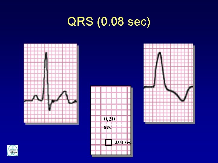 QRS (0. 08 sec) 0, 20 sec 0, 04 sec 