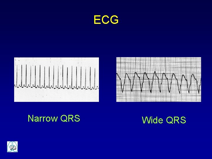 ECG Narrow QRS Wide QRS 