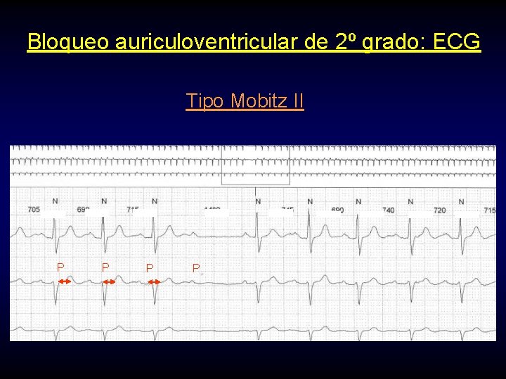 Bloqueo auriculoventricular de 2º grado: ECG Tipo Mobitz II P P 