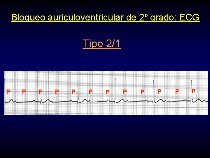 Bloqueo auriculoventricular de 2º grado: ECG Tipo 2/1 P P P 