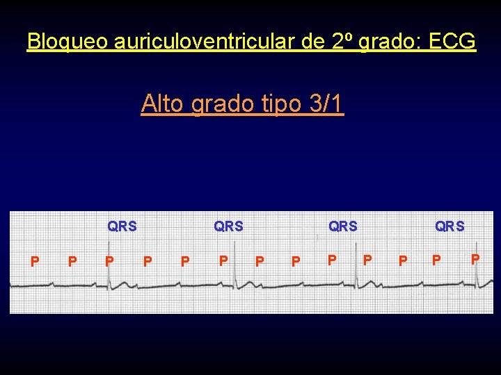 Bloqueo auriculoventricular de 2º grado: ECG Alto grado tipo 3/1 QRS P P P