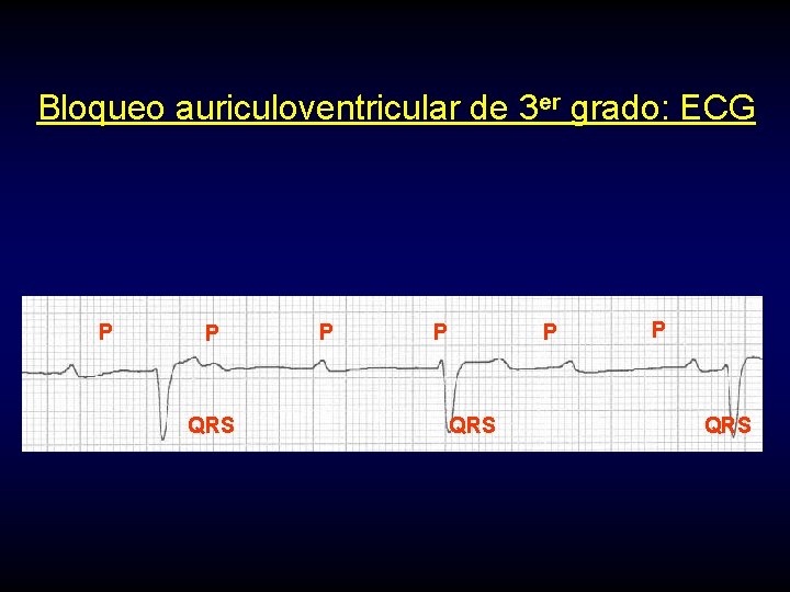 Bloqueo auriculoventricular de 3 er grado: ECG P P QRS 