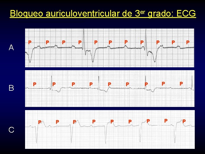 Bloqueo auriculoventricular de 3 er grado: ECG A B P P P C P