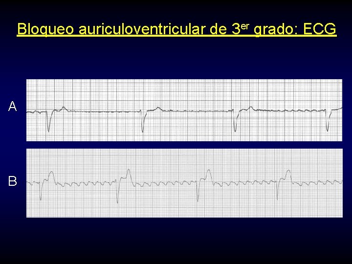 Bloqueo auriculoventricular de 3 er grado: ECG A B 