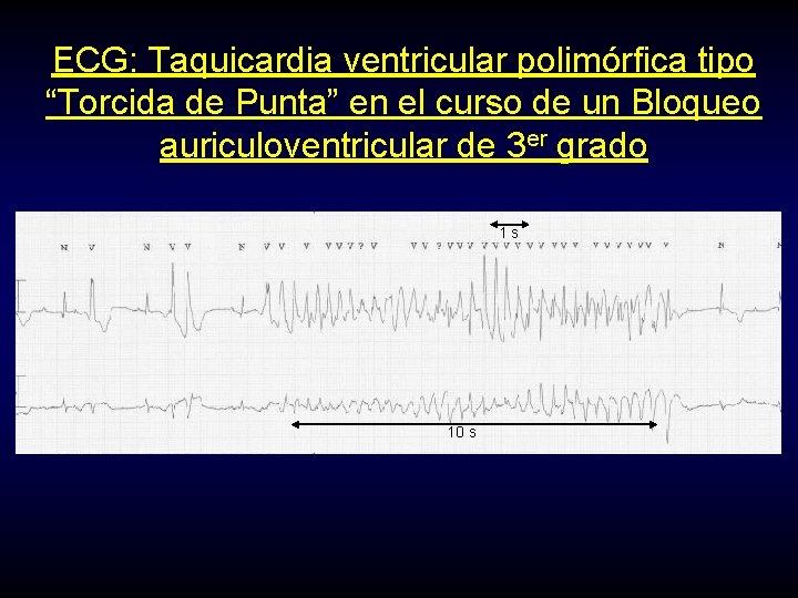 ECG: Taquicardia ventricular polimórfica tipo “Torcida de Punta” en el curso de un Bloqueo