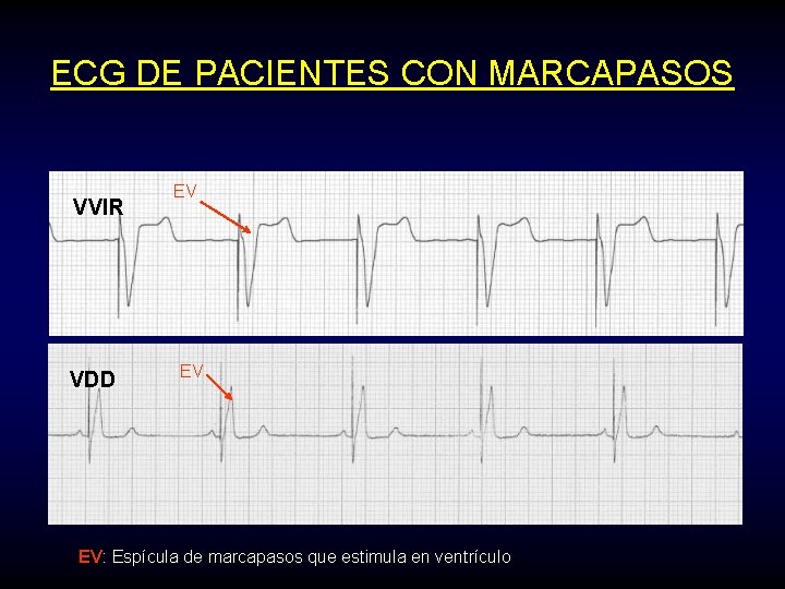 ECG DE PACIENTES CON MARCAPASOS VVIR VDD EV EV EV: Espícula de marcapasos que