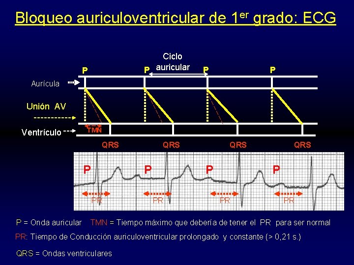 Bloqueo auriculoventricular de 1 er grado: ECG Ciclo P auricular P P P Aurícula